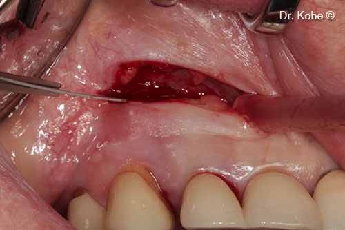 Rạch ngang (NIPSA) ở tiền đình