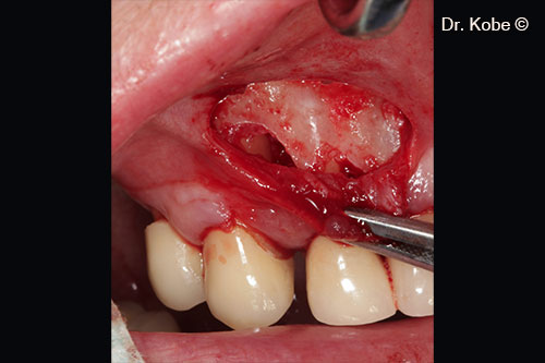 Bề mặt rễ được làm sạch