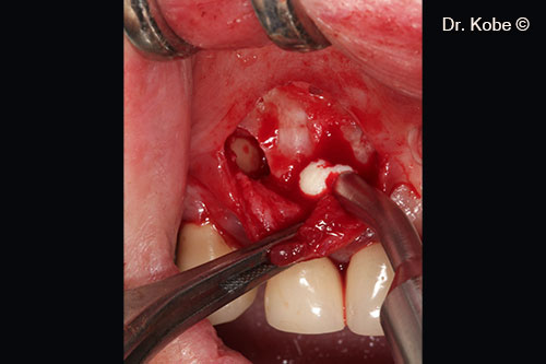 Vết khuyết được lấp đầy bằng Gel 40