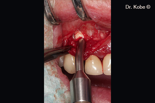 Vết khuyết được lấp đầy bằng Gel 40