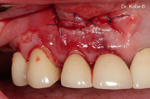 Vết thương được khâu bằng mũi khâu gián đoạn