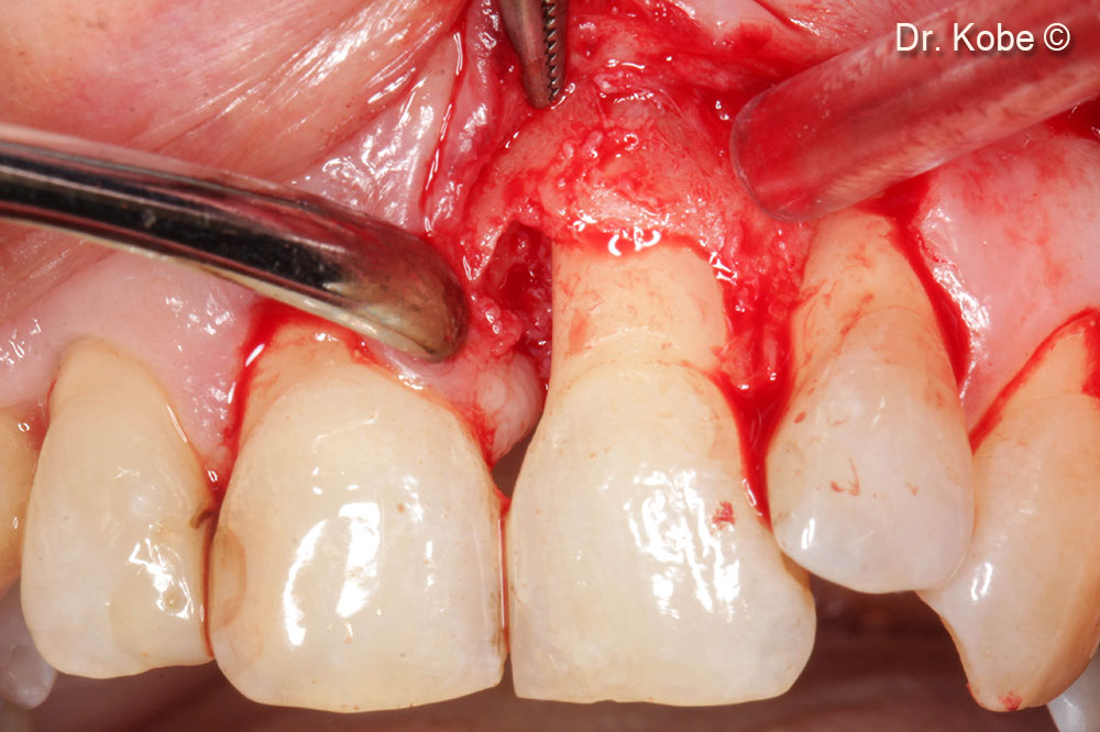 Tiếp cận và làm sạch khu vực bị lỗi