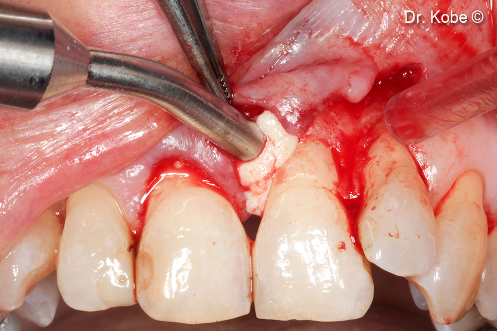 Vết khuyết được lấp đầy bằng Gel 40