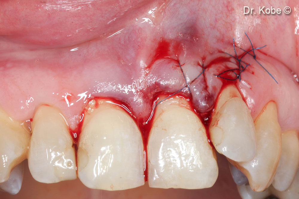 Khâu vết thương bằng vết khâu đơn giản gián đoạn