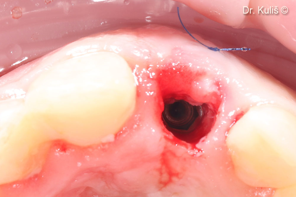 Lộ phần nền tảng cấy ghép