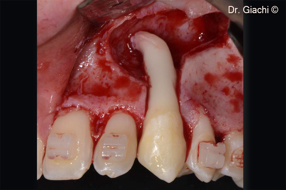 Định vị răng nanh sau khi thiết kế ổ răng bằng phẫu thuật.