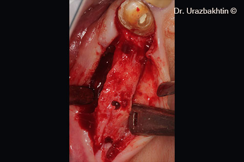 Lắp đặt cấy ghép nha khoa Astra Tech TX