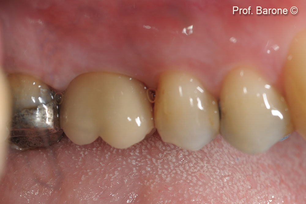Phục hình cuối cùng sau 3 năm theo dõi.