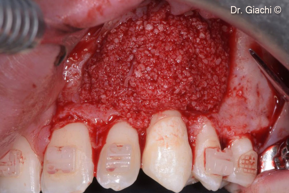 Nẹp cố định sau phẫu thuật tự ghép