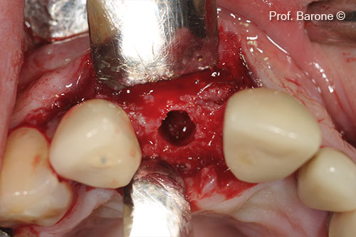 Chuẩn bị vị trí cấy ghép