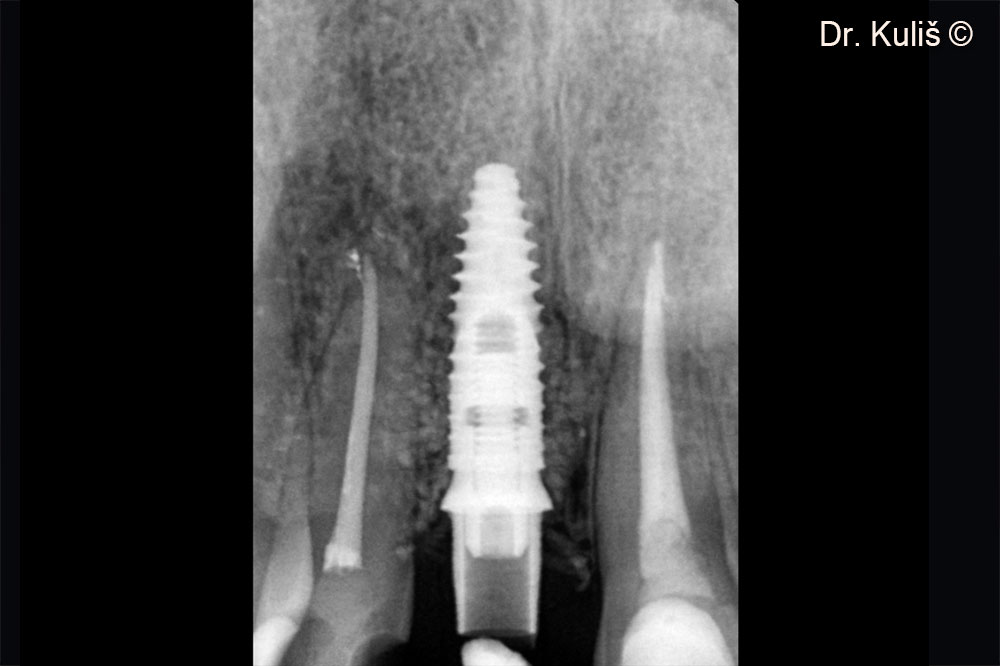 Ảnh chụp X-quang sau giai đoạn thứ hai