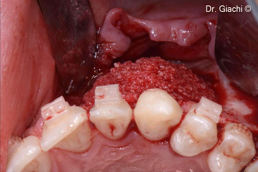 Tái tạo xương bằng vật liệu sinh học collagen có khả năng tự tiêu hoàn toàn – hình ảnh nhìn từ phía tiền đình