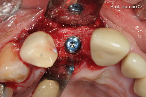 Cấy ghép implant vào sống hàm đã được tăng cường