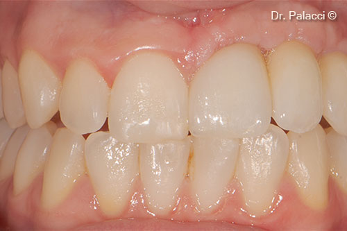 Hình ảnh nhìn từ phía trước. Hãy chú ý sự  gia tăng theo chiều dọc và chiều ngang của mô