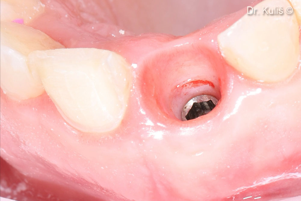 Hồ sơ hình thành và phức hợp trên mào xương cấy ghép