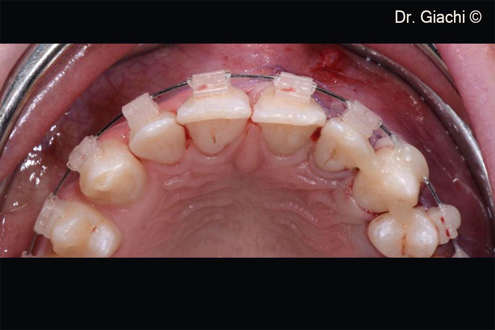 Bảo vệ mô ghép bằng màng L-PRF
