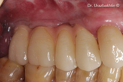 Hình ảnh cấu trúc chỉnh hình 8 năm sau phẫu thuật.