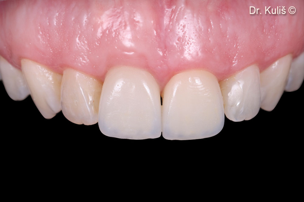 Kết quả cuối cùng sau 6 tháng kể từ khi đặt phục hình toàn sứ hoàn chỉnh.