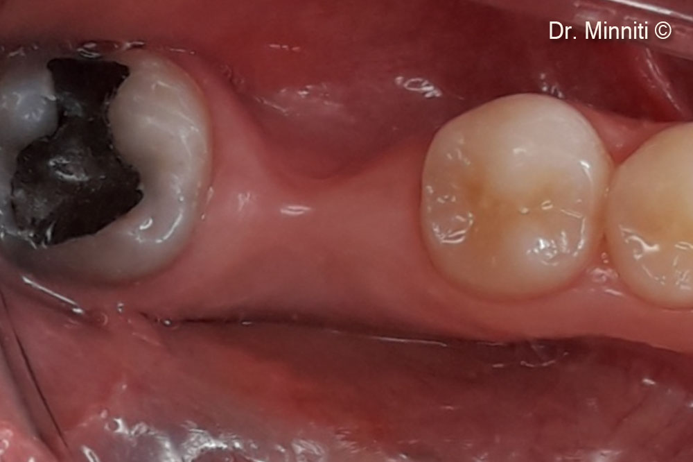 Hình ảnh lâm sàng trước phẫu thuật - vùng chóp tim