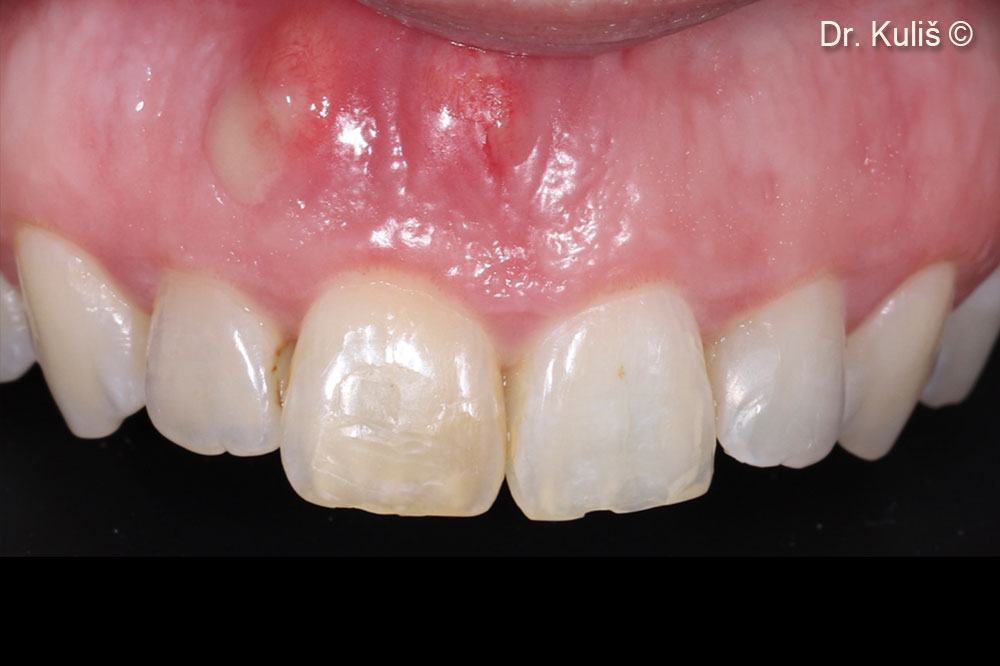 Tình trạng ban đầu. Dịch mủ do tổn thương quanh chóp răng cửa giữa bên phải.