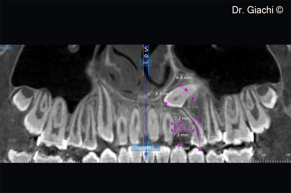 Chụp CBCT trước phẫu thuật – Răng nanh trên không thể phục hồi bằng phương pháp chỉnh nha truyền thống.