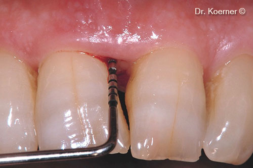 Súng ngắn bỏ túi 9mm