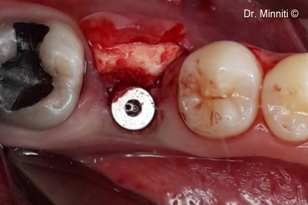 Derma 2mm được sử dụng làm dày mô mềm quanh vùng cấy ghép