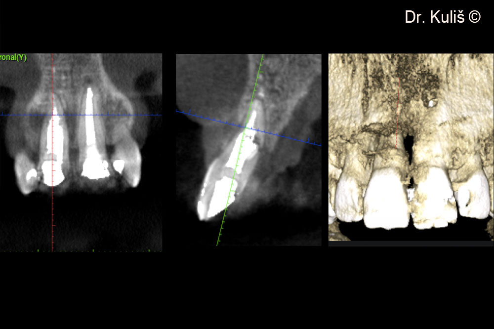 Hình ảnh chụp CBCT ban đầu cho thấy khuyết tật xương má với sự thiếu hụt hoàn toàn xương má.