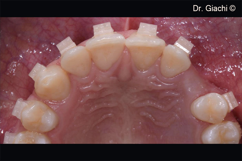 Điều trị chỉnh nha nhằm tạo khoảng trống thích hợp