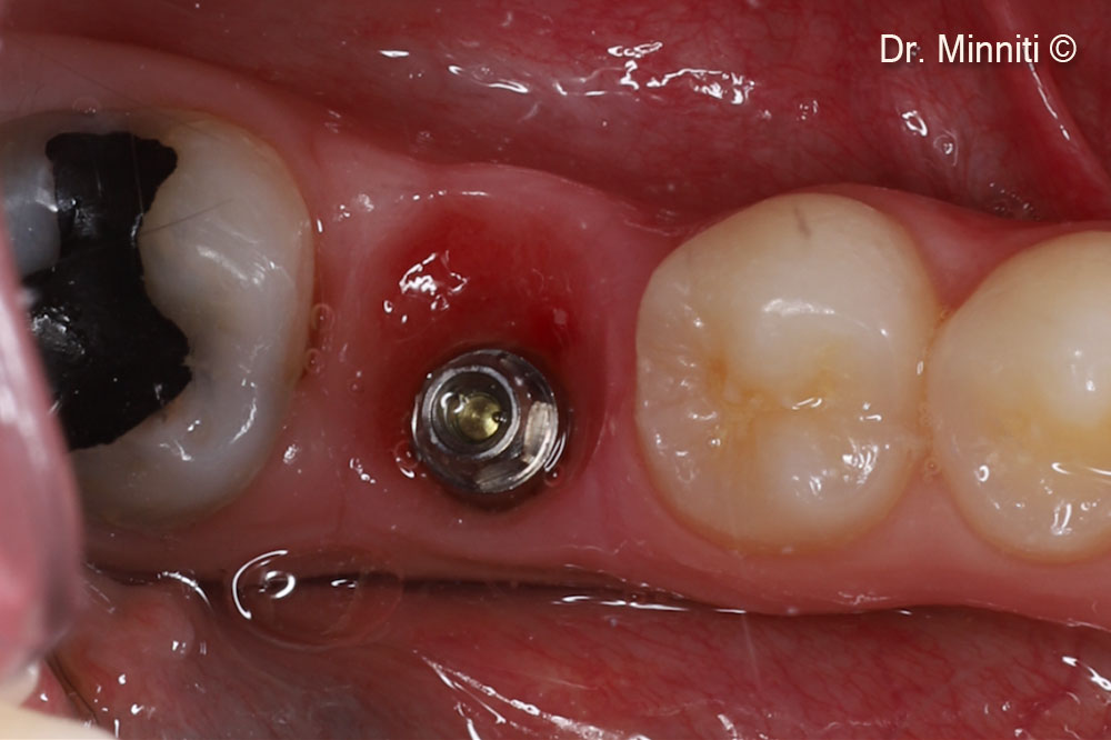 Theo dõi trong 1 năm