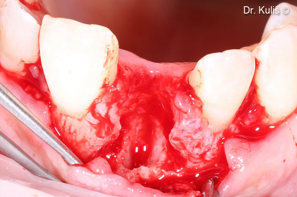 Khuyết tật xương má sau khi nhổ răng và loại bỏ mô hạt