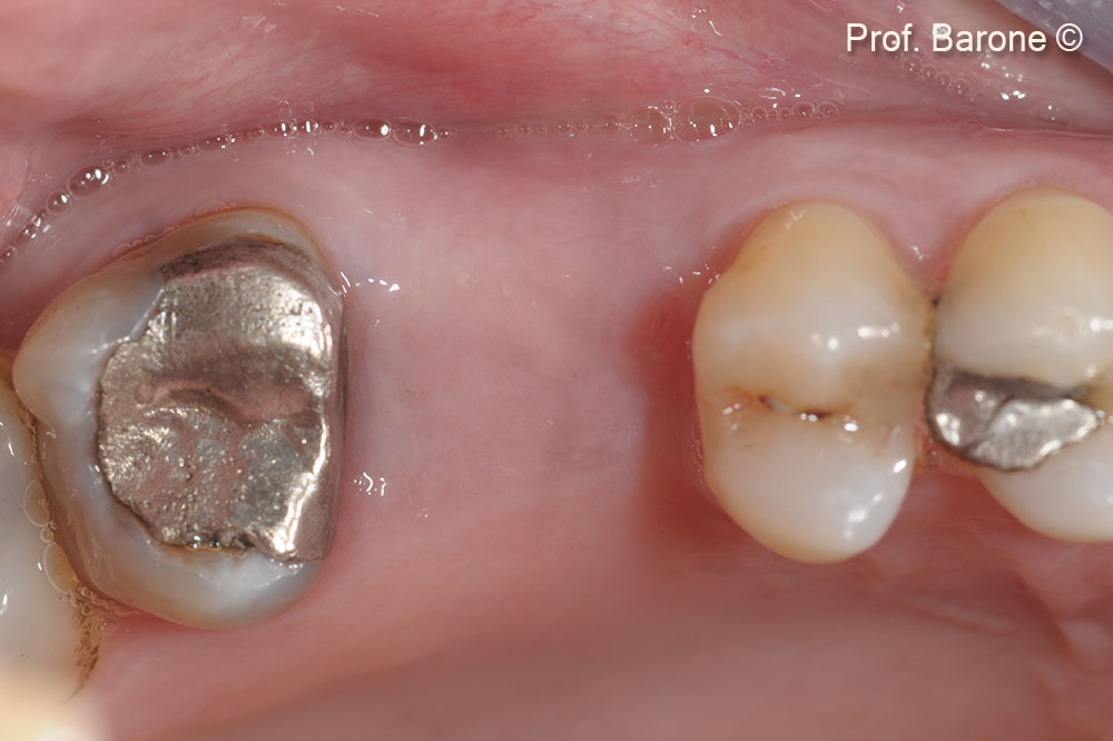 Quá trình hồi phục sau 4 tháng.