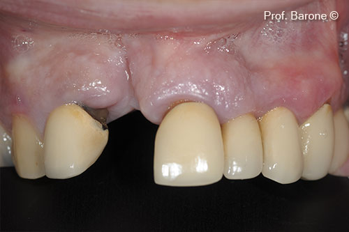 Quá trình phục hồi sau 3 tháng