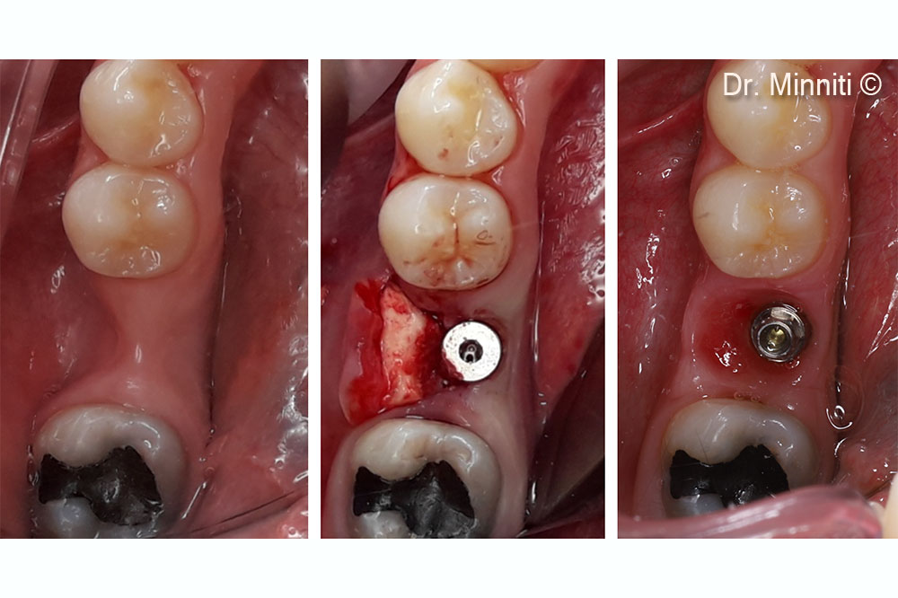 Theo dõi trong 1 năm