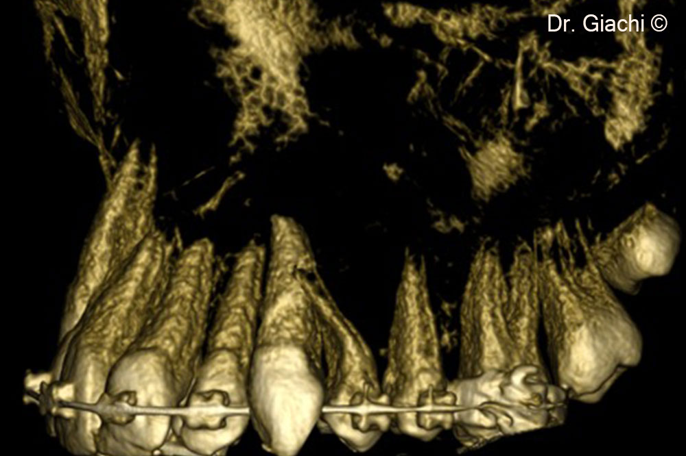 Hình ảnh CBCT mô phỏng vị trí tự ghép