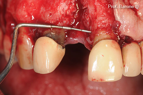 Khuyến khuyết xương còn sót lại kích thước gần xa