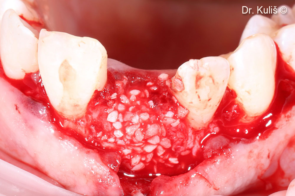 Tăng cường xương bằng mp3®