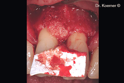 Lỗi được khắc phục bằng mp3® và màng Evolution được thiết kế riêng