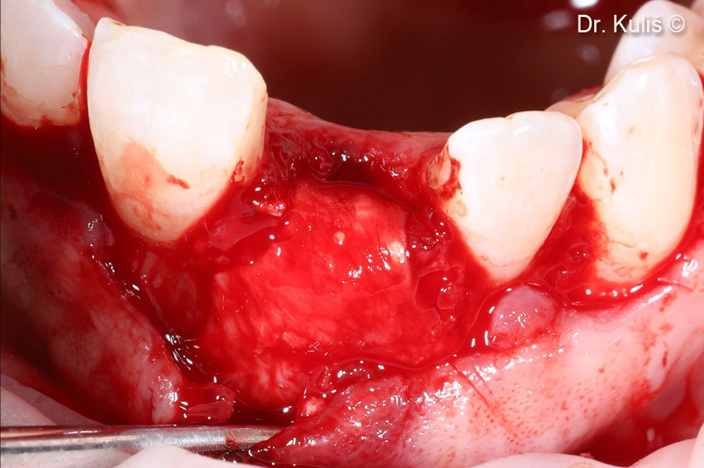 Màng tế bào Evolution đã được điều chỉnh để phù hợp với khiếm khuyết.