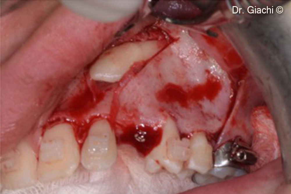 Chuẩn bị kỹ lưỡng vùng phẫu thuật để tiến hành nhổ răng.