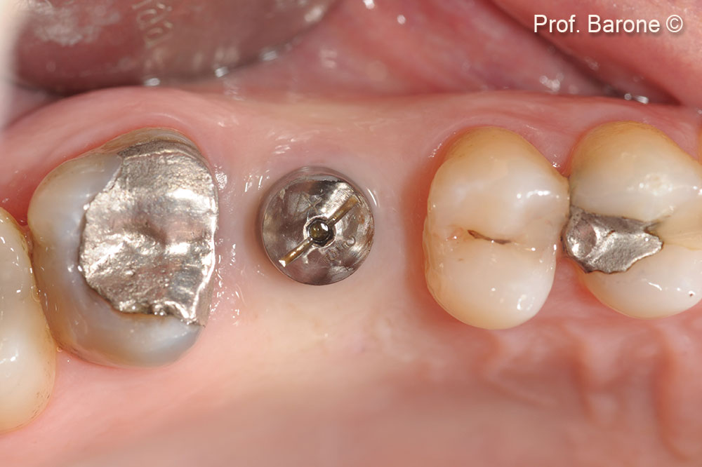 Cấy ghép implant sau 5 tháng