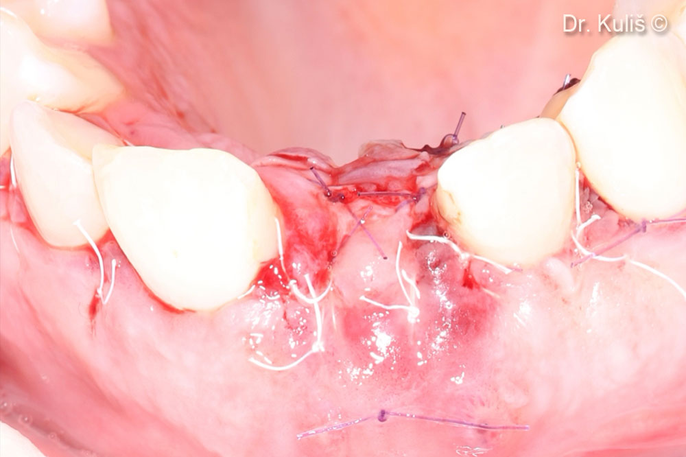 Màng và lỗ của ổ nhổ răng được che phủ bằng vạt cuống vòm miệng.