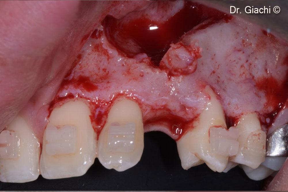 Nhổ răng không gây chấn thương và bảo tồn vỏ não tiền đình.