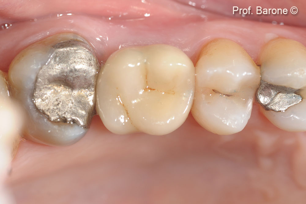 Phục hình cuối cùng, Hình chiếu mặt nhai