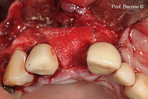 Lamina soft giúp bảo vệ mô mềm