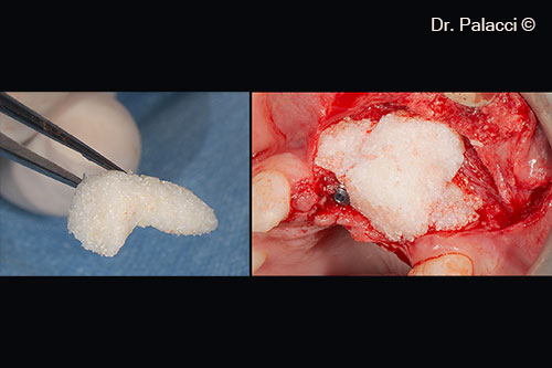 Một lớp bổ sung được đặt ở vị trí yên ngựa để tăng chiều cao theo phương thẳng đứng