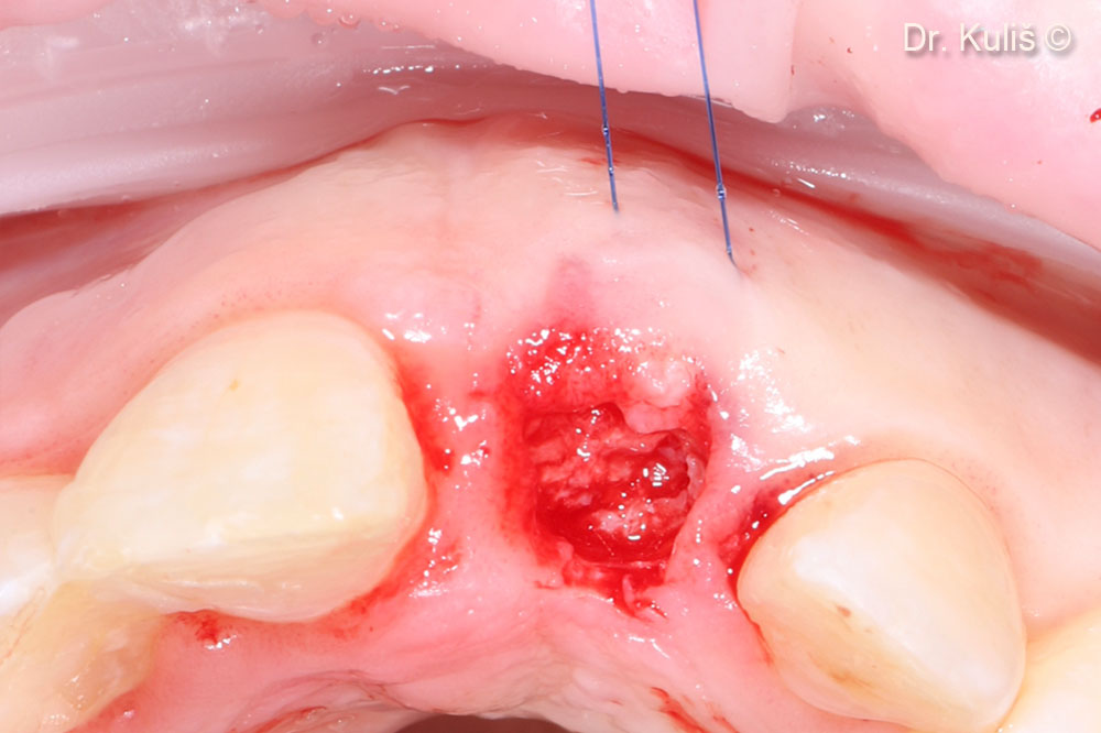 Ca phẫu thuật giai đoạn hai được thực hiện theo phương pháp xâm lấn tối thiểu bằng kỹ thuật vạt cuộn. Hình ảnh cho thấy sự hình thành xương tốt phía trên bệ cấy ghép.