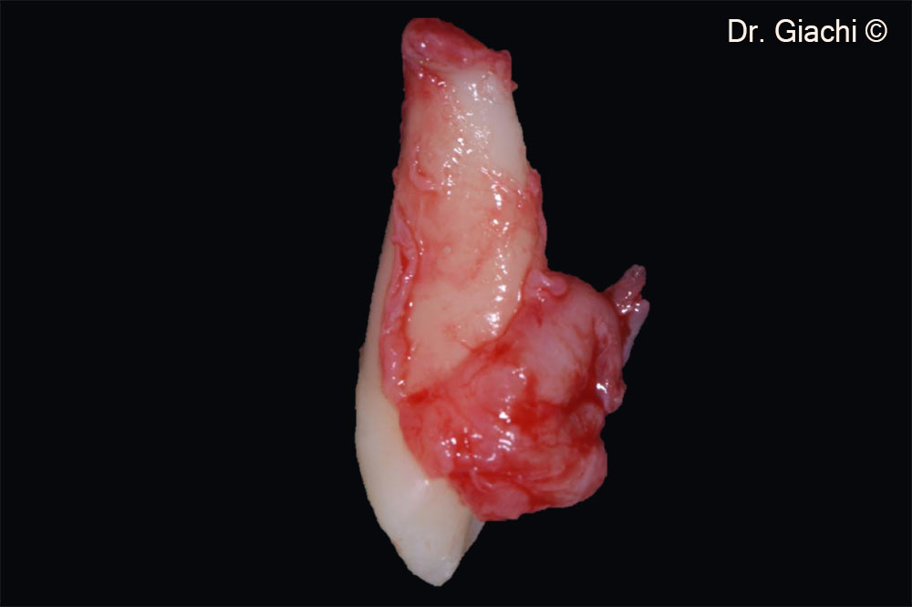 Nhổ nang lông chó với việc bảo tồn nang lông ở 3 trong 4 phần xung quanh gốc.