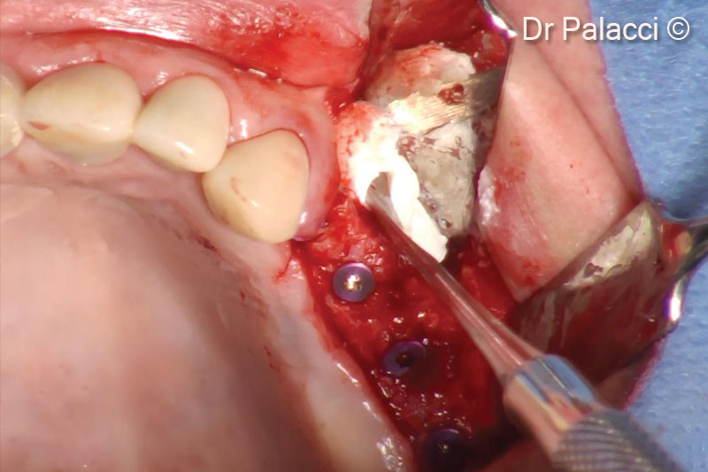 Vùng lõm ở phần chóp của răng tiền hàm thứ nhất được lấp đầy bằng GTO để tái tạo hình dạng sống hàm tự nhiên