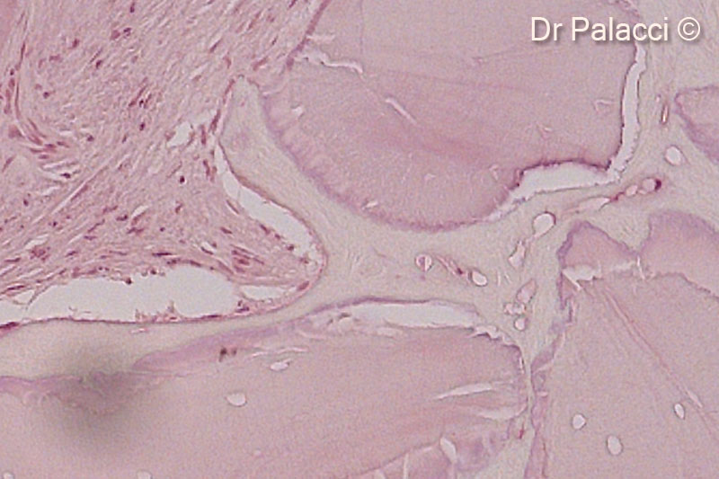 Một phần mẫu sinh thiết được lấy 4 tháng sau khi tăng cường bằng GTO. Các hạt vật liệu sinh học được bao quanh bởi xương mới hình thành, có sự hiện diện của các hốc tế bào xương